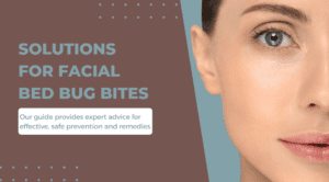 Solutions for Facial Bed Bug Bites