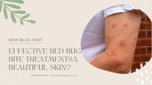 Effective Bed Bug Bite Treatments