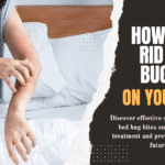 How to Get Rid of Bed Bug Bites on Your Back