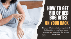 How to Get Rid of Bed Bug Bites on Your Back